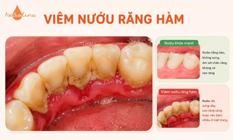 Viêm nướu răng hàm thường kèm hình ảnh cao răng vàng bám nhiều ở mặt trong