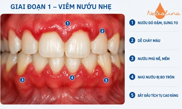 Hình ảnh viêm nướu giai đoạn 1