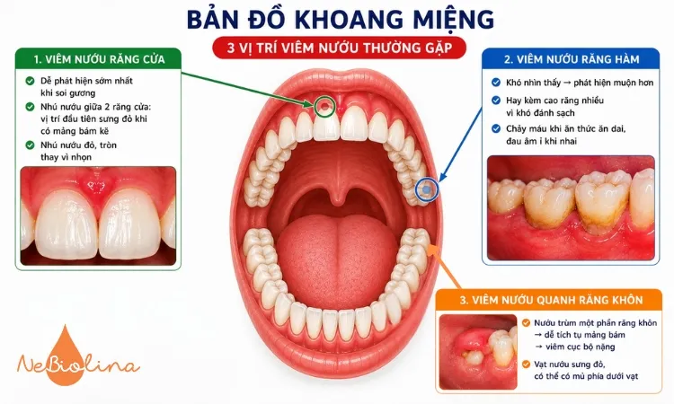 Hình ảnh viêm nướu răng ở trẻ theo từng vị trí khác nhau.