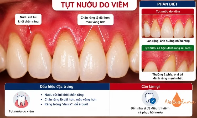 Hình ảnh tụt nướu do viêm và do cơ học.