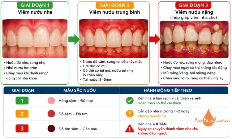 Viêm nướu nặng hình ảnh thường cho thấy nướu đỏ tím, tụt sâu.