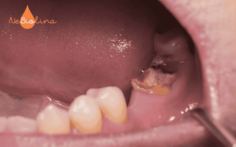 Sâu răng không được chữa trị sớm có nguy cơ phải nhổ bỏ