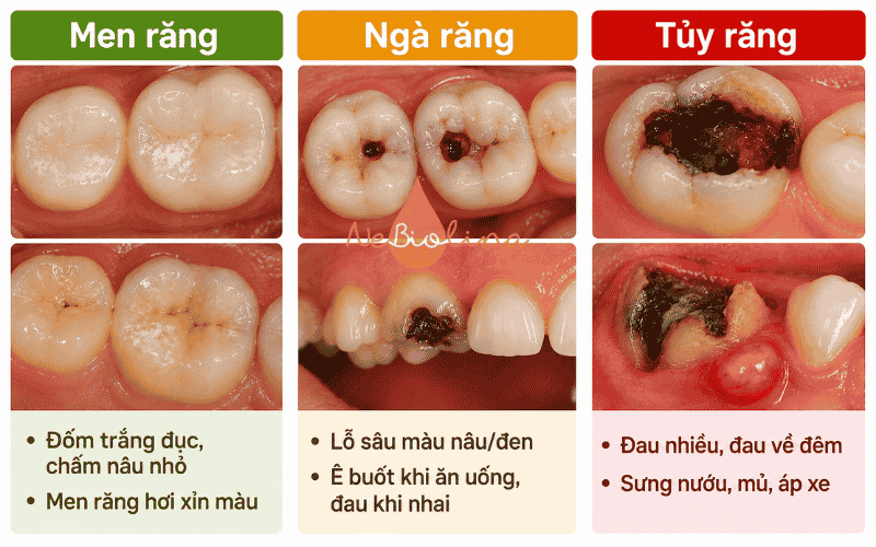 Các giai đoạn của sâu răng