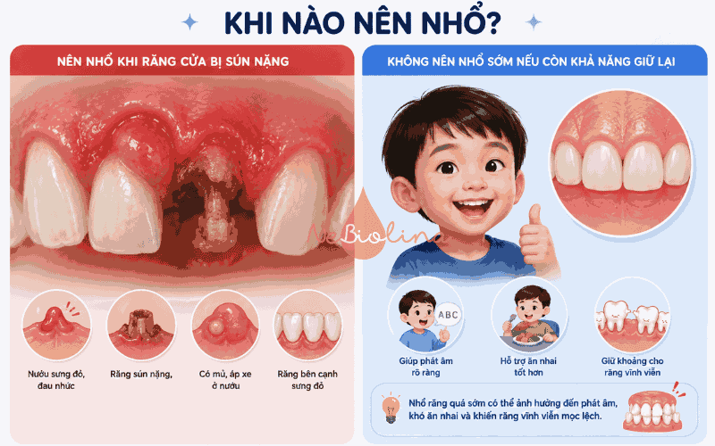 Chỉ nên nhổ khi răng sún nặng gây viêm nhiễm