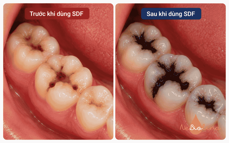 Dùng dung dịch SDF có thể gây đổi màu răng