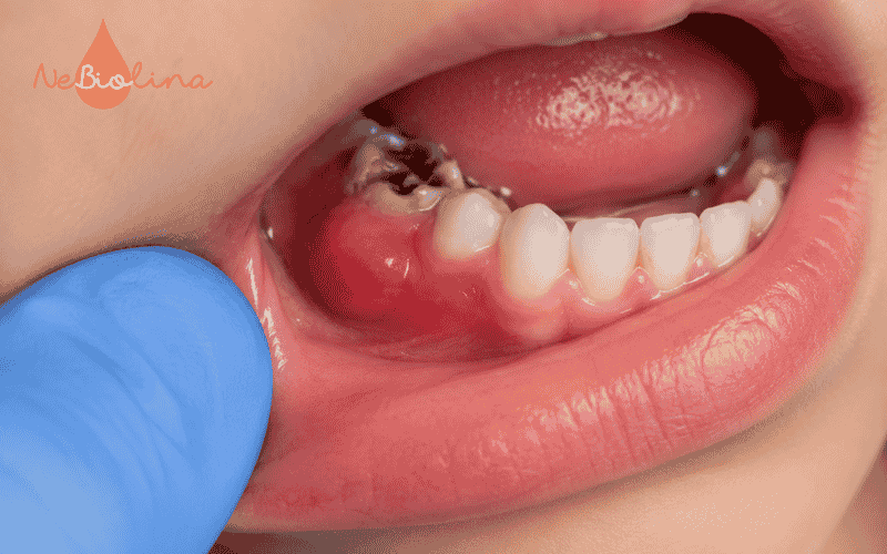 Viêm tủy gây viêm và áp xe lợi
