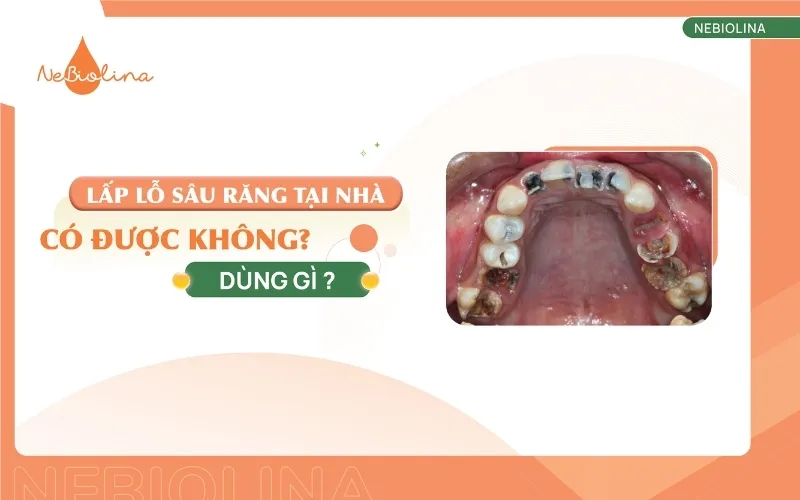 Lấp lỗ sâu răng