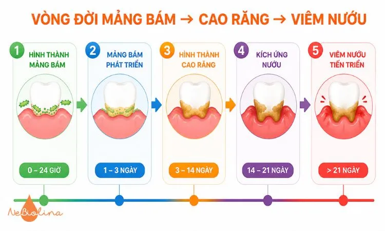 Mảng bám tích tụ lâu ngày có thể chuyển thành cao răng và gây viêm nướu.