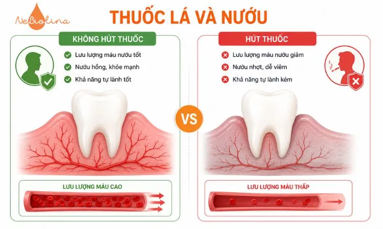 Thuốc lá làm giảm lưu lượng máu đến nướu và tăng nguy cơ viêm nướu.