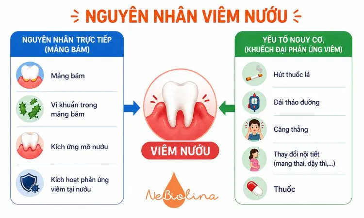Sơ đồ nguyên nhân viêm nướu