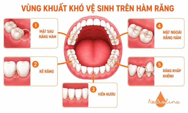 Các vùng khuất khó vệ sinh trên hàm răng