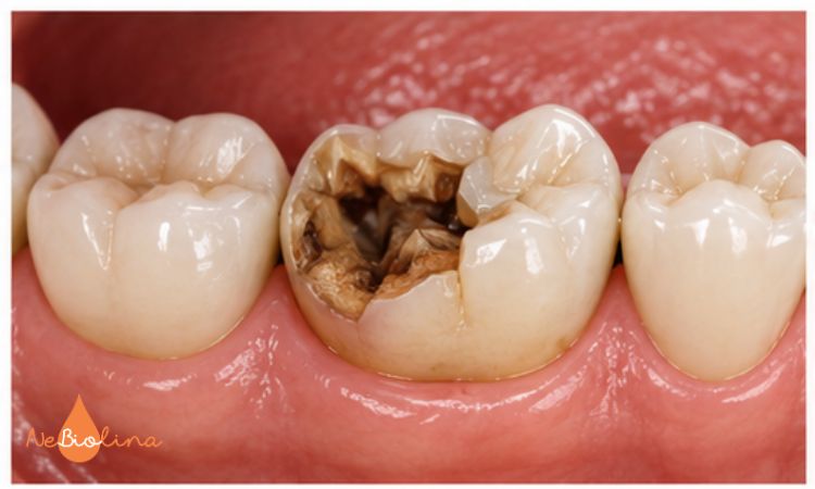 Hình ảnh răng số 7 bị sâu vỡ lớn do sâu răng kéo dài.
