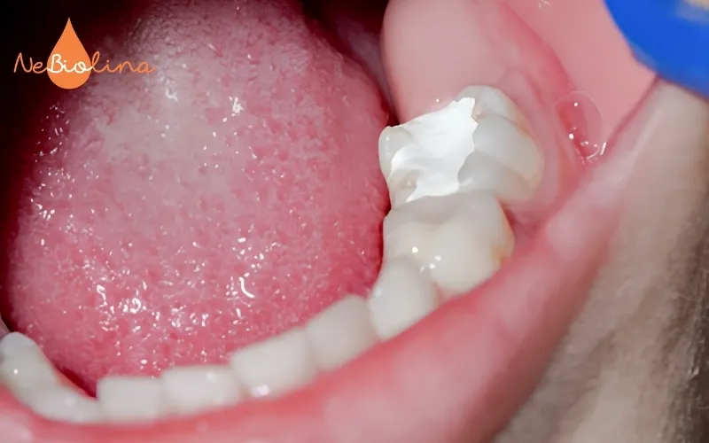 Trám răng ngăn sâu răng tiến triển nặng