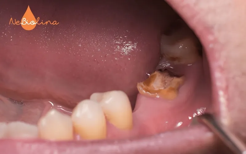 Sâu răng không được chữa trị sớm có nguy cơ phải nhổ bỏ