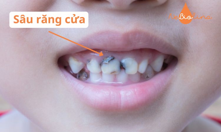 Sâu răng cửa 