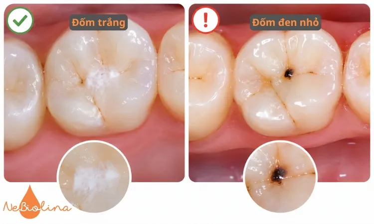 Dấu hiệu cảnh báo sâu răng nhẹ.