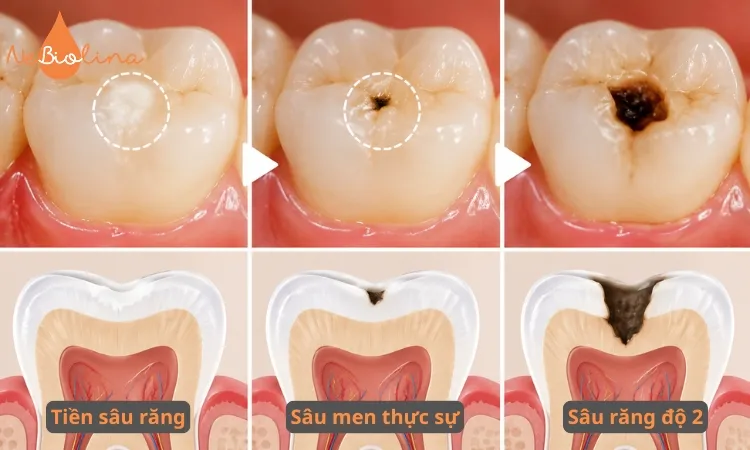 Hình ảnh sâu răng nhẹ qua từng giai đoạn. 