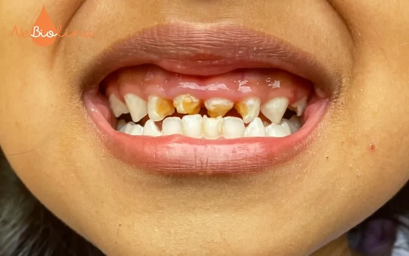Răng cửa tiếp xúc vi khuẩn lâu hơn các răng khác nên dễ bị sún