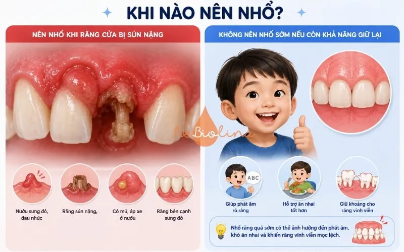 Chỉ nên nhổ khi răng sún nặng gây viêm nhiễm