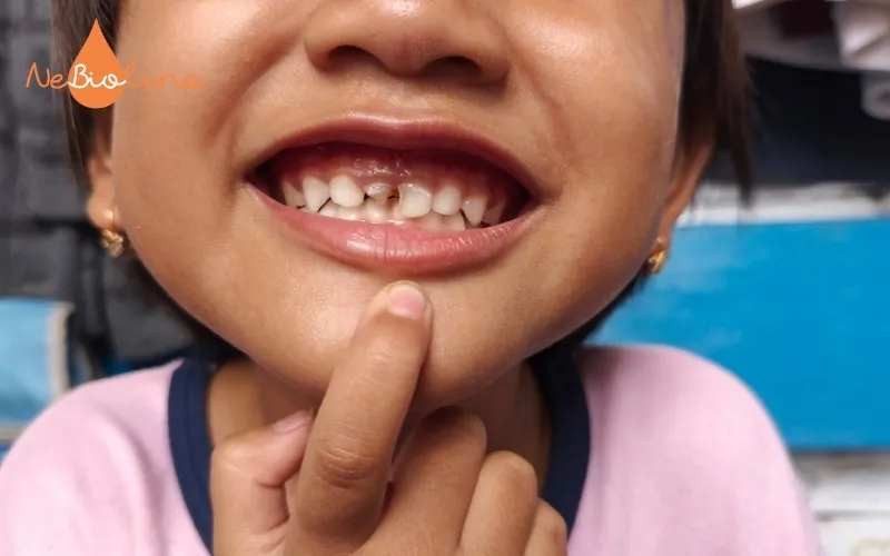 Trẻ sún răng ảnh hưởng tới thẩm mỹ và tăng nguy cơ vi khuẩn xâm nhập