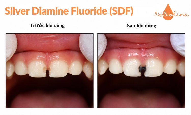 SDF làm vùng sâu răng chuyển màu đen.