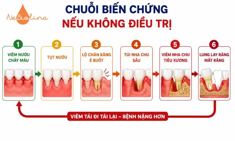 Biến chứng của viêm nướu nếu không điều trị. 