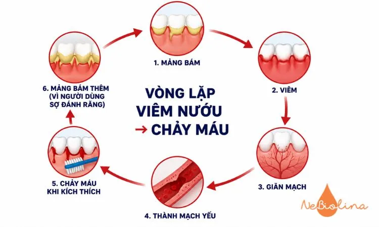 Vòng xoắn bệnh lý của viêm nướu và chảy máu chân răng.