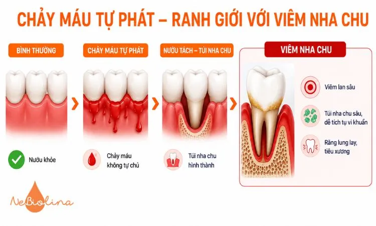 Chảy máu nướu tự phát có thể là dấu hiệu viêm nha chu. 