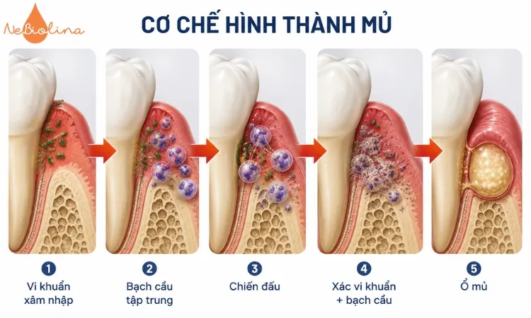 Vi khuẩn xâm nhập vào mô nướu, gây viêm và hình thành ổ mủ. 