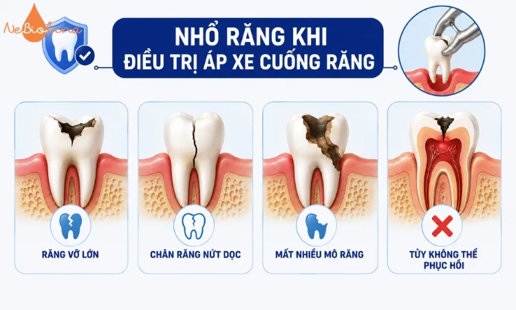 Một số trường hợp yêu cầu nhổ răng khi điều trị áp xe cuống răng. 