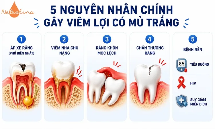 Viêm lợi có mủ trắng bắt nguồn từ nhiều nguyên nhân khác nhau.