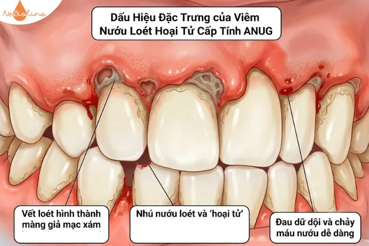 Nhú nướu bị loét