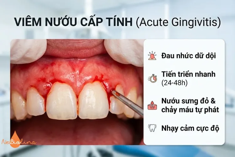 Viêm nướu cấp tính là gì?
