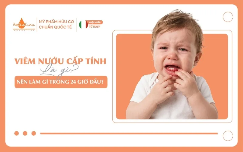 Viêm nướu cấp tính