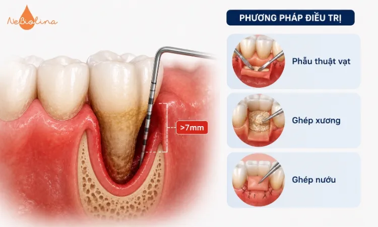 Túi nha chu vượt quá 7mm cần thực hiện phẫu thuật nha chu