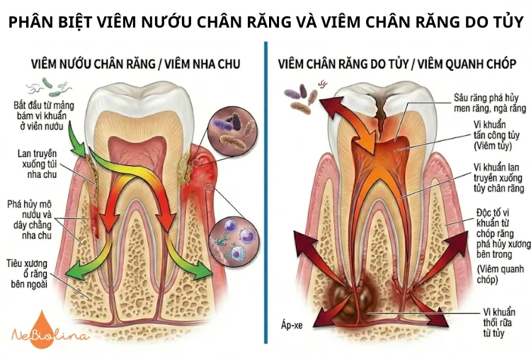 Phân biệt giữa viêm nướu chân răng và viêm chân răng do tủy