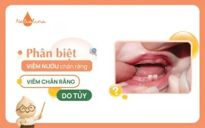 Viêm nướu chân răng