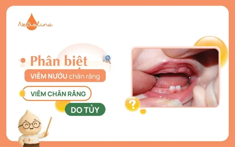 Viêm nướu chân răng