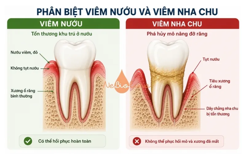 Phân biệt viêm nướu và viêm nha chu