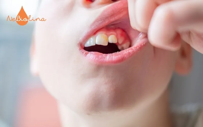 Trẻ bị viêm nướu khu trú phần răng nanh