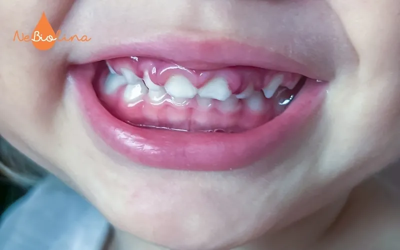 Viêm nướu là gì-Bé bị viêm nướu toàn bộ phần hàm trên