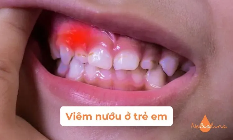 Hình ảnh trẻ bị viêm nướu