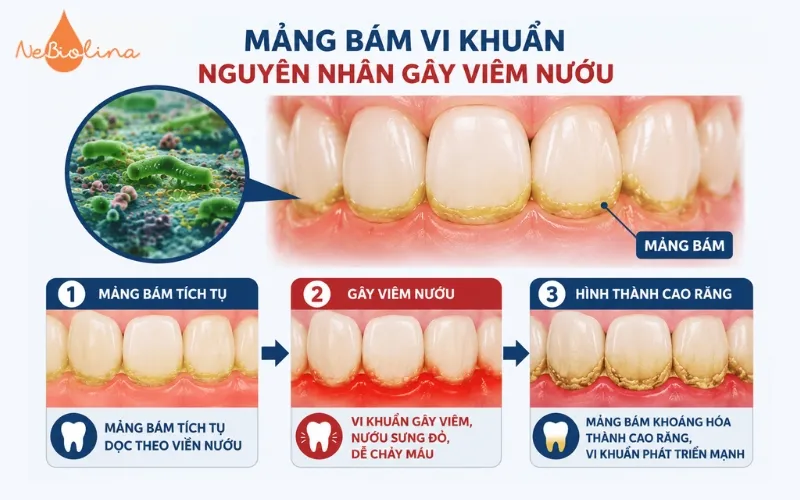 Viêm nướu răng do mảng bám 