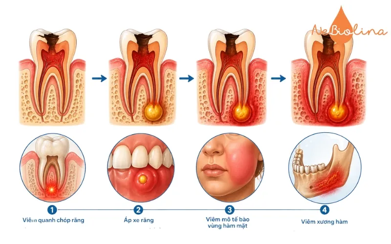 Biến chứng của viêm tủy răng nếu không điều trị kịp thời