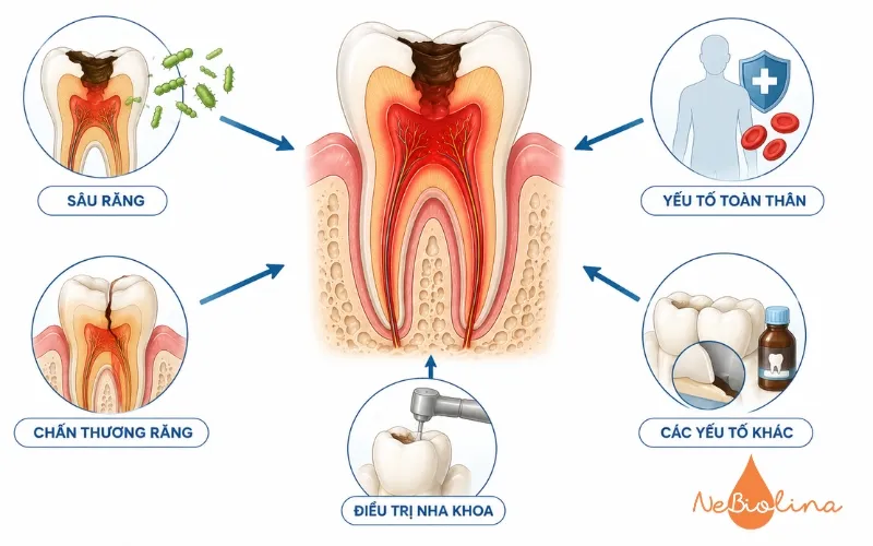 Nguyên nhân gây viêm tủy răng