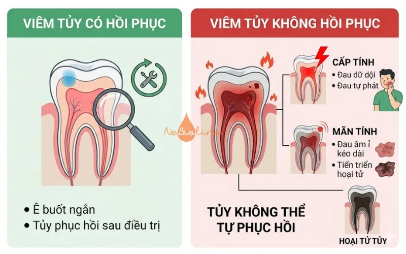 Phân loại viêm tủy răng