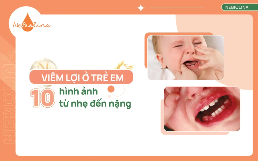 Hình ảnh viêm lợi ở trẻ em