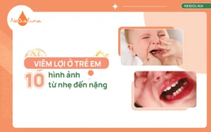 Hình ảnh viêm lợi ở trẻ em