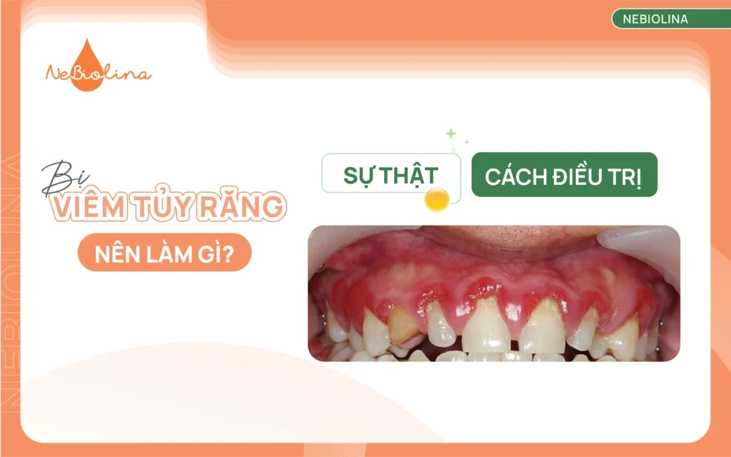 Bị viêm tủy răng nên làm gì Cách xử lý và điều trị