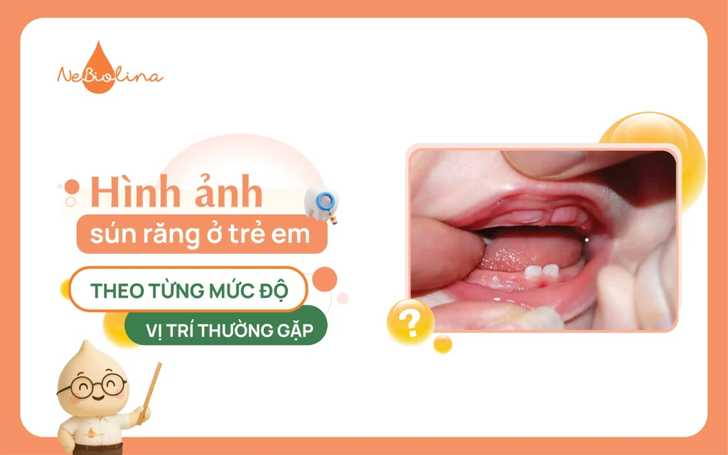 Hình ảnh sún răng ở trẻ em theo từng mức độ và vị trí thường gặp